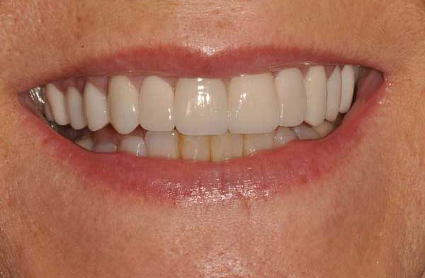 Woman's mouth after dental veneers